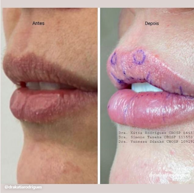www.drakatiarodrigues.com.br-home-preenchimentolabial.png